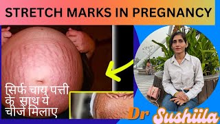 Remove Stretch Marks at Home  Pregnancy Ke Stretch Marks Hataye Naturally  stretchmarks [upl. by Ecnerual]