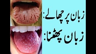 Zaban ke chale ka ilaj in urduHow to get Rid of Burning Mouth Syndrome [upl. by Ybbil438]