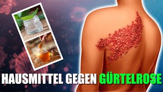 10 Natürliche Hausmittel gegen Gürtelrose [upl. by Amethyst935]