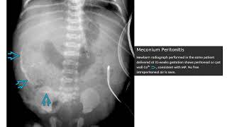 Meconium Peritonitis Imaging [upl. by Kelleher]