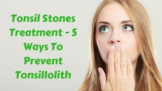 Tonsil Stones Treatment  5 Ways To Prevent Tonsillolith [upl. by Ahsiniuq]