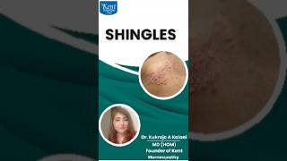 Treatment of shingles in homeopathy [upl. by Acinet]