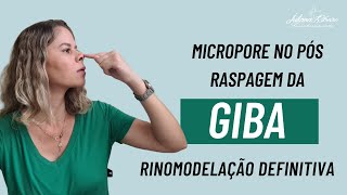 Raspagem de giba e micropore rinomodelacaodefinitiva rinoplastiaestruturada posoperatorio [upl. by Barkley]