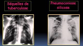 RADIOLOGIE ATELECTASIE Lobaire et segmentaire 2 [upl. by Hurd]