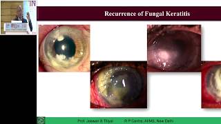 AIOC2019 IC458 Topic Therapeutic keratoplasty in microbial keratitis Dr Jeewan S Titiyal x2 [upl. by Meridith860]