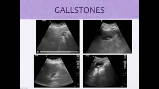 GB Stone vs Polyp [upl. by Netloc]