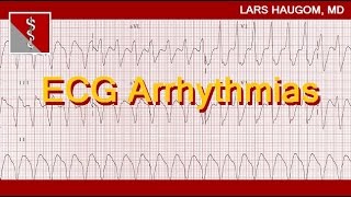 ECG Arrhythmias [upl. by Joon]