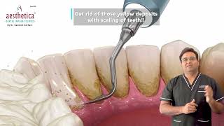 Say Goodbye to Yellow Deposits with Professional Teeth Scaling [upl. by Llerehs]