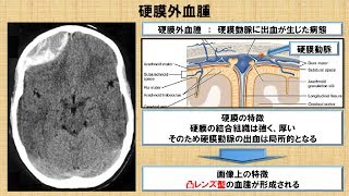 CTの特徴及び脳画像の診方 ～No43 理学療法士国家試験対策 シリーズ～ [upl. by Watkin582]