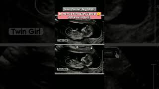 👶🏻How to Find Boy OR Girl🤔 ultrasound youtubeshorts pregnancy baby gender babyboy ytshorts [upl. by Northway]