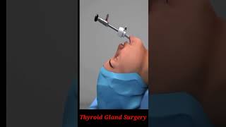 Thyroid Gland Surgery  Thyroid gland  viral youtubeshorts shorts short [upl. by Anrat]