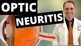 Optic Neuritis Symptoms Diagnosis and Treatment [upl. by Merwyn96]