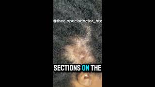 This Condition Causes Scalp Lesions and Permanent Hair Loss [upl. by Leverett575]