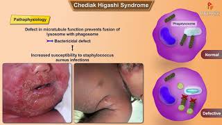 ChediakHigashi syndrome [upl. by Elijah]