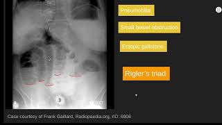 Rigler’s triad radiology abr core [upl. by Reivaz]