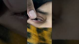 eye infection motivation opthalmology cataracttreatment automobile opthalmic eyesurgery news [upl. by Yllitnahc]