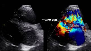 Double chamber right ventricle echocardiography DCRV [upl. by Ennovehc]