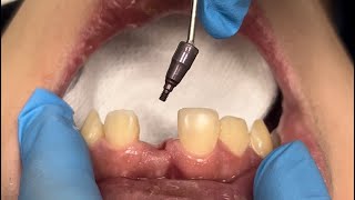 Dental Implants  Bone Graft [upl. by Merchant]