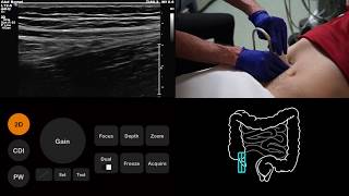 Ultrasound Tutorial AppendixAppendicitis  Radiology Nation [upl. by Airpac]