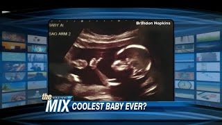 Baby Gives a ThumbsUp In Ultrasound Photo [upl. by Woermer]