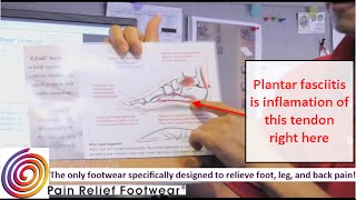 Plantar Fasciitis explained by ZCoiL [upl. by Mathi]