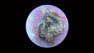 Tympanic membrane perforation and postoperative debridement for cholesteatoma 28 [upl. by Ishmael]