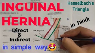 Inguinal Hernia Anatomy 12  Direct and Indirect Inguinal Hernia  Abdomen  Anatomy [upl. by Hakkeber]