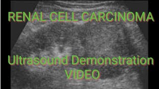 RENAL CELL CARCINOMA on Ultrasound Video Demonstration [upl. by Gregorius10]