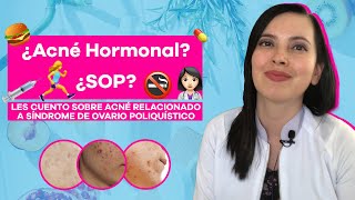 ¿Acné hormonal Síndrome de ovario poliquístico y piel [upl. by Siuqram]