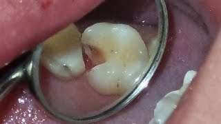 Endodontia Microscópica  dente 16  canal e restauração [upl. by Svirad25]