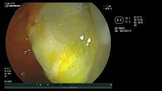 ruptured hydatid cyst in the common bile duct [upl. by Inger532]