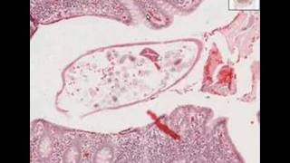 Histopathology AppendixPinworms [upl. by Nosyaj]