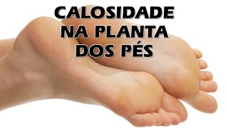 CALOSIDADE NA PLANTA DOS PÉS  Valcapelli Responde [upl. by Gwenore]