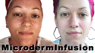 Microderm Infusion Facial  Informative Video [upl. by Nilek166]