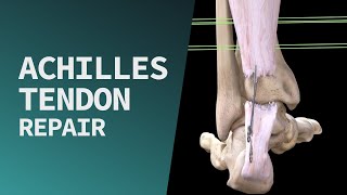 Achilles Tendon Repair [upl. by Esoj804]