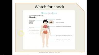 Epistaxis Causes and Management Part 2 [upl. by Stubstad]