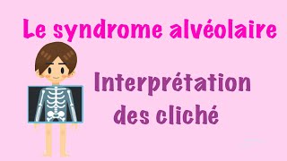 📍syndrome alvéolaire RADIO [upl. by Vaclav]