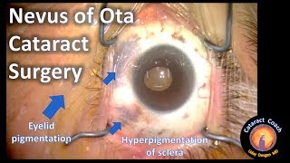 Nevus of Ota Cataract Surgery [upl. by Garcia904]