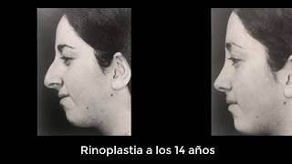 Rinoplastia ¿a que edad [upl. by Eiknarf]