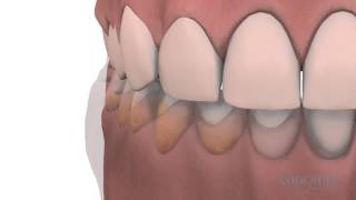 Gingivoplasty and gingivectomy  Lapointe dental centres [upl. by Elspeth]