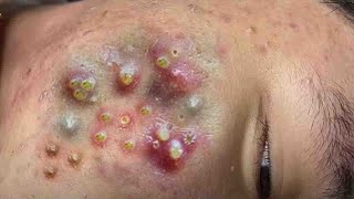 Big Cystic Acne Blackheads Extraction Blackheads amp Milia Whiteheads Removal Pimple Popping  9177 [upl. by Annim50]