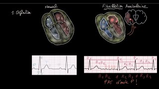 Fibrillation auriculaire  Définition  Impact  Evaluation  Anticoag  HH  FC  Rythme [upl. by Boy898]