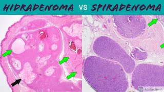 Hidradenoma Acrospiroma vs SpiradenomaCylindroma 5Minute Pathology Pearls [upl. by Ineslta]