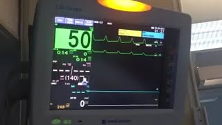 心電図モニター 実際の測定 BRADY徐脈 NIHONKOHDEN LifeScope VS [upl. by Eenehs]