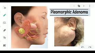 PLEOMORPHIC ADENOMA  SALIVARY GLAND TUMOR  ORAL PATHOLOGY  ORAL CANCERS [upl. by Leventhal822]