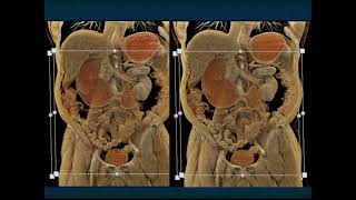 CT of the Small Bowel Inflammatory Disease  Part 1 [upl. by Samal]