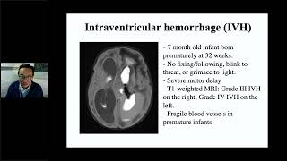 CVI Webinar Expert Panel from Pediatric Ophthalmology and NeuroOphthalmology and Parent Perspective [upl. by Nidnerb]