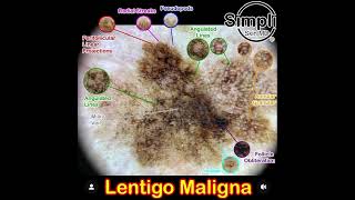 Lentigo Maligna Melanoma [upl. by Ylloj223]