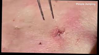 The Most Satisfying Pimple Popping Compilation Youll Ever Watch pimple popping acne blackheads [upl. by Nerrual]