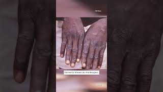 Mpox Outbreak Is Public Health Emergency shorts [upl. by Alyehc]